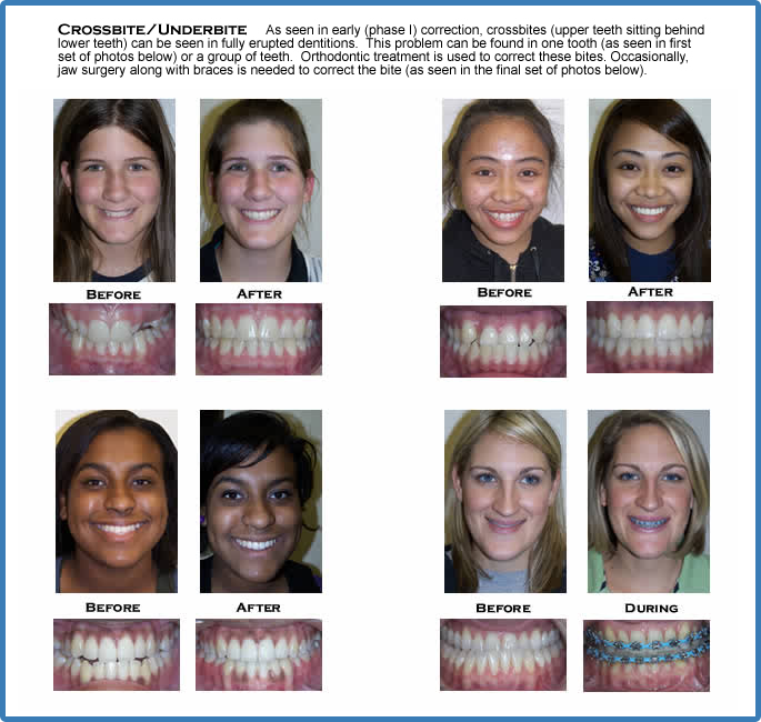 Crossbite/Underbite